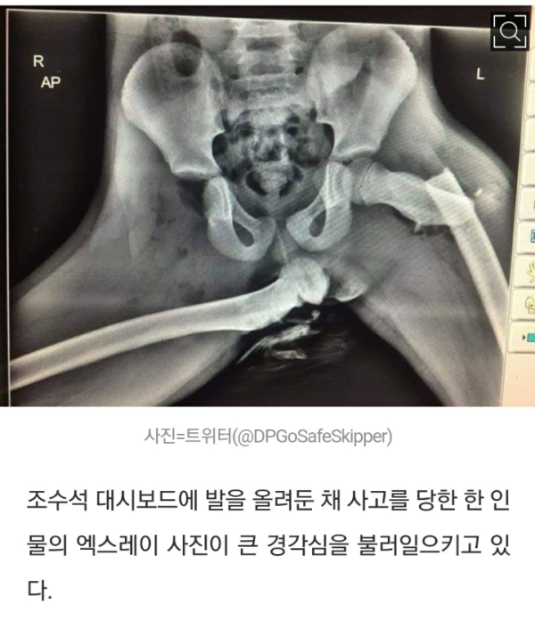 대시보드에 발 올린채로 사고난 사람의 X-RAY